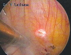 Sublimation of peritoneal endometriosis with SwiftLase (laparoscopic image). 